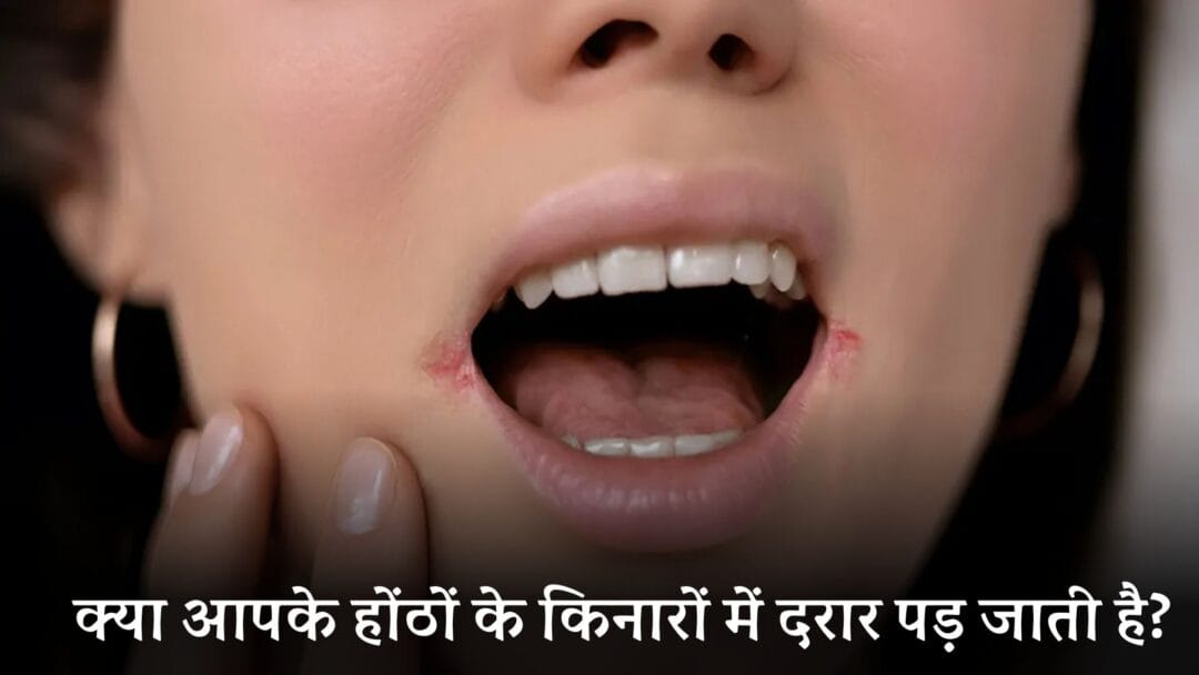 hontho ke kinare darar: क्या आपके होंठों के किनारों में दरार पड़ जाती है? जानें कारण और बचाव