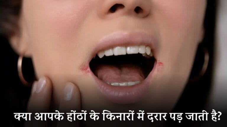 hontho ke kinare darar: क्या आपके होंठों के किनारों में दरार पड़ जाती है? जानें कारण और बचाव